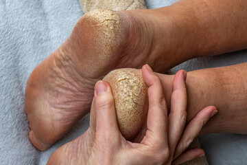 Cracks on the heels of a person's foot, foot health problems, neglected heel of a person. A doctor examines a man's cracked heels. Close-up. The concept of treating cracked heels