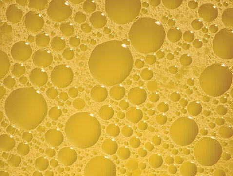 High color frothy urine with bubbles. Foamy excretion.