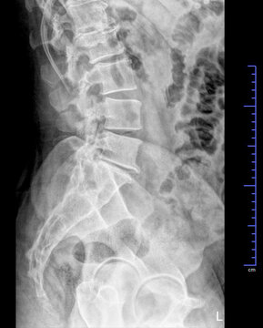 X-ray radiograph of the pelvis and spinal column , side view