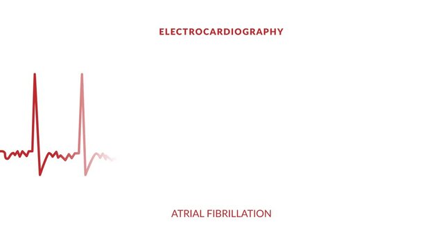 Atrial Fibrillation Images – Browse 3,013 Stock Photos, Vectors, and ...