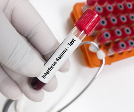 Scientist holds blood sample for Interferon gamma test to diagnosis of tuberculosis. IGRA test.