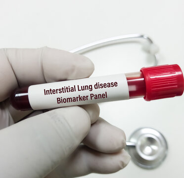 Technologist holds blood sample for Interstitial Lung Disease biomarker panel test.