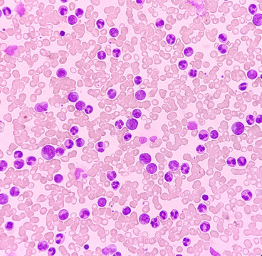 Blood cancer. Chronic myeloid leukemia(CML) with Thrombocytopenia. Chronic myelogenous leukemia. show myelocytes, Neutrophils.