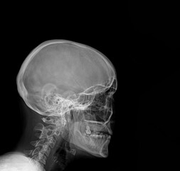 X-ray of a human skull, lateral view