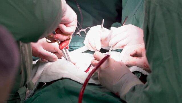 Kyiv, Ukraine - April 2023: Surgeons perform a heart operation. Operating room. Doctors perform heart surgery. Doctors hands close-up