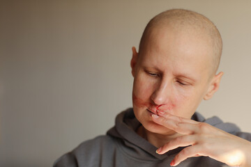 Hairless cancer sick female patient is bleeding from her nose, effects of chemotherapy. Young bald...