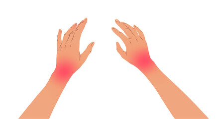 Vector illustration of hands with carpal tunnel syndrome