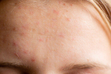 Fototapeta premium Pimples on forehead of teenager girl. Close-up of skin with inflammation. Adolescence, adolescence. Close-up. Small pimples all over surface of forehead.