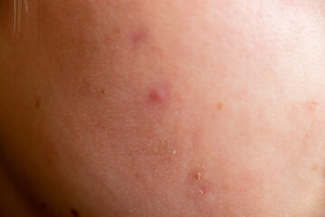Skin with close-up macro pimples. Skin problems, dermatology.