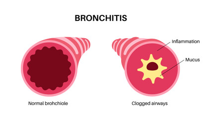 Bronchitis lung disease