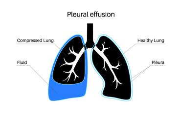 Pleural effusion poster