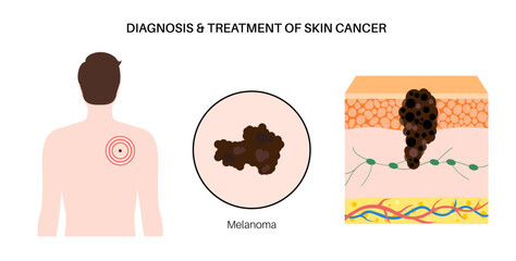 Skin cancer diagnosis