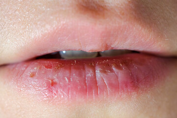 Macro lips with severely dry bleeding cracked or chapped lips. close up