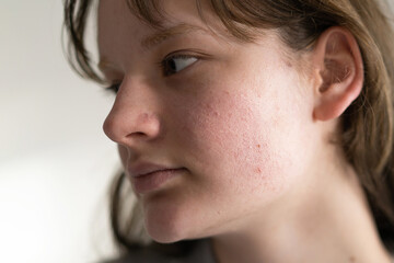 Problem skin face. A teenage girl with a troubled face. Problematic teenage skin. Care for problem...