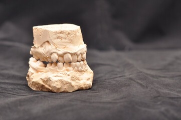 Plaster model or cast of human teeth. Strongly crooked teeth.
