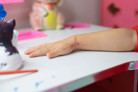 (selective focus) Red rash on skin from allergic reactions. baby rash skin, prickly heat on wrists and arms baby while doing activities.