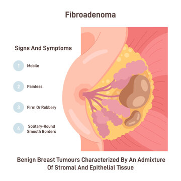 Fibroadenoma. Neoplasm in female chest. Benign breast tumour