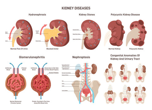 Kidney diseases set. Renal failure, urinary system organ medical