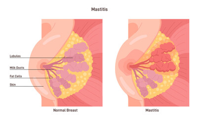 Fototapeta na wymiar Mastitis. Mammary gland with inflammation of the breast lobular