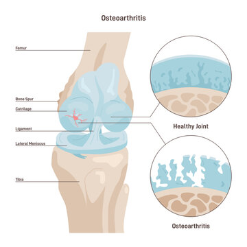 Osteoarthritis. Degenerative joint disease. Worn out knee cartilage.