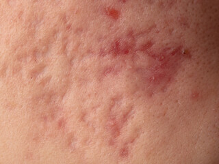 Fototapeta premium Acne scars on the skin. Macro.