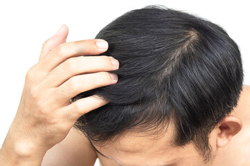 Closeup Young man serious hair loss problem with white backgroun for health care medical and shampoo product concept, selective focus