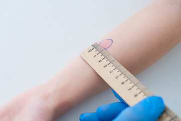 A male doctor makes an important Mantoux test on a child. The doctor measures the Mantoux test with a ruler for a little boy