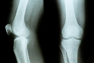 X-ray of a patient with a torn meniscus of the knee joint in a man and diagnostics of the knee joint