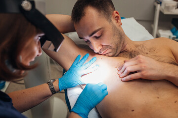 Obraz na płótnie Canvas Laser removal of warts on the body in the clinic