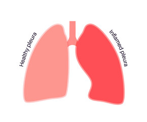 Fototapeta premium Pleurisy inflammation diseases