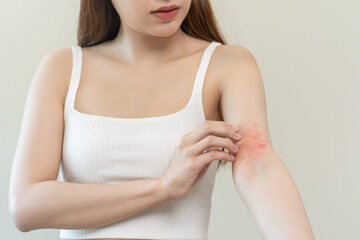 Dermatology asian young woman, girl allergy, allergic reaction from atopic, insect bites on her...