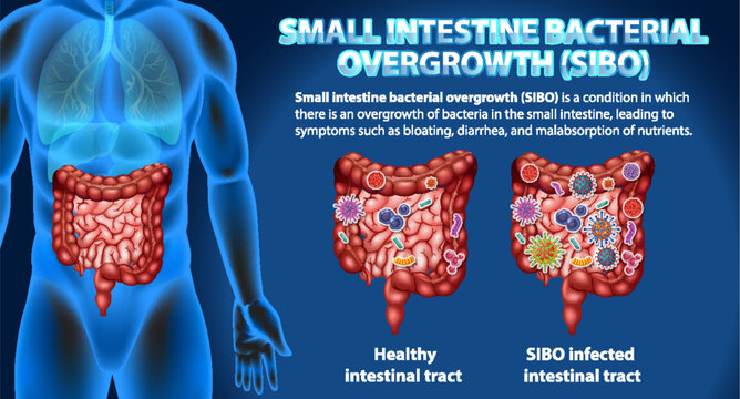 Small Intestine Bacterial Overgrowth (SIBO)