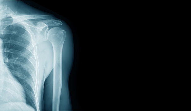 x-ray image of shoulder for medical diagnosis