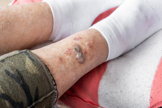 Ulcers and skin diseases, dried scabs and fresh wounds on the legs of an elderly woman, Health concept, senile changes