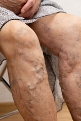 Vertical unrecognizable elderly woman bare legs with varix, spider varicose veins medical...