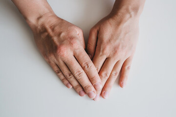 Fototapeta premium Rashes on the skin of a young woman's hands. Skin itching, eczema, skin allergies.
