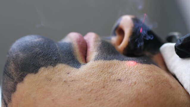 Skin care cosmetology. Laser therapy and skin treatment. Carbon face peeling procedure. Closeup of the laser pulses clean skin of the face. Hardware cosmetology treatment. Process of warming the skin