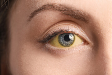 Obraz premium Young woman with yellow eyes, closeup. Hepatitis symptom