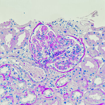 Camera photo of lupus nephritis, showing endocapillary hypercellularity and hyaline thrombi, magnification 400x, photograph through a microscope