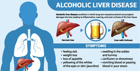 Informative poster of alcoholic liver disease Cirrhosis