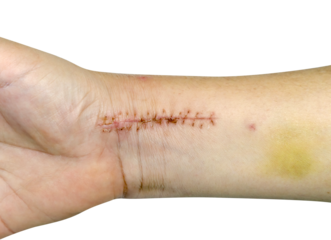 closeup stitches from broken arm surgery and bruised isolated