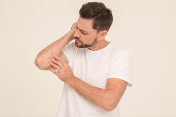 Man with rash suffering from monkeypox virus on beige background