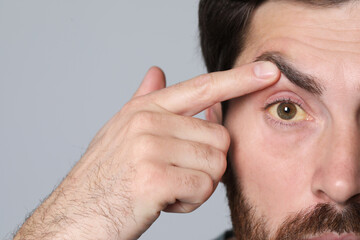 Man with yellow eyes on grey background, closeup. Symptom of hepatitis