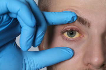 Doctor checking yellow eyes of patient on light grey background, closeup. Hepatitis symptom