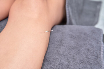Close-up of an acupuncture needle inserted into the leg of a patient during an acupuncture therapy session - obrazy, fototapety, plakaty