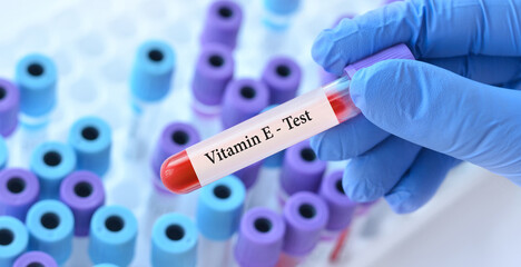 Fototapeta premium Doctor holding a test blood sample tube with Vitamin E test on the background of medical test tubes with analyzes.Banner.Copy space for text