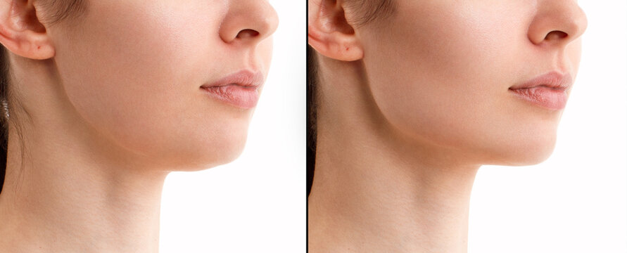 A close portrait of a woman before and after the facial rejuvenation procedure. Correction of the chin shape liposuction of the neck. Fillers in the cheekbones and chin. The result of the procedure in