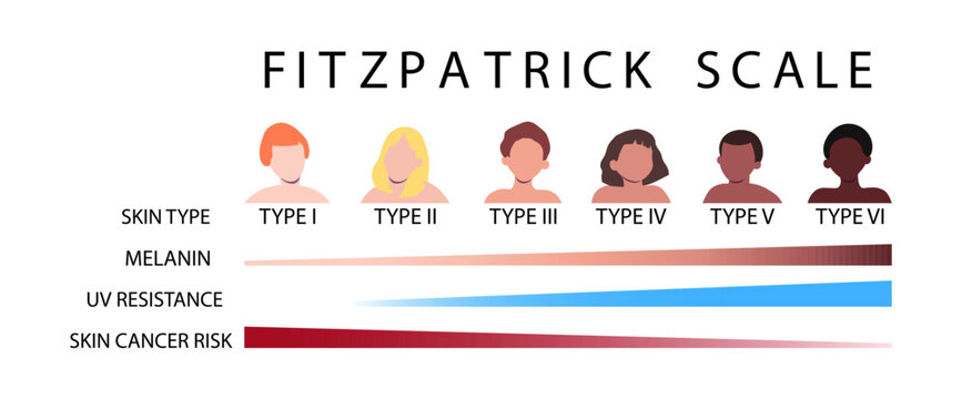 Fitzpatrick scale. Skin types infographic with male and female faceless characters. Human phototypes. Melanin, UV resistance, skin cancer risk diagrams. Vector illustration