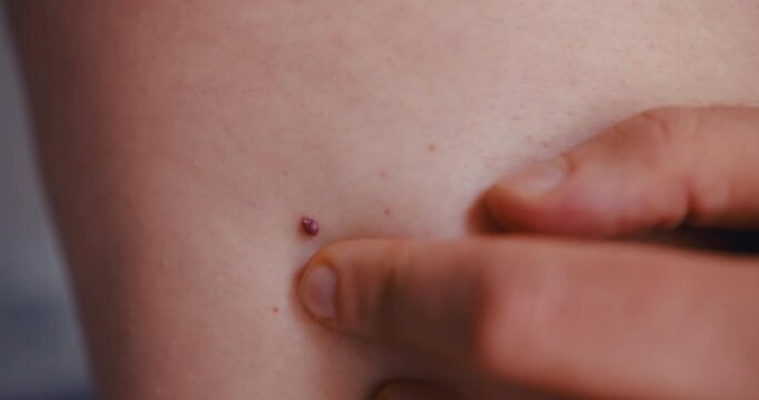 Mole birthmark nevus macro on man skin, self inspection. Close up