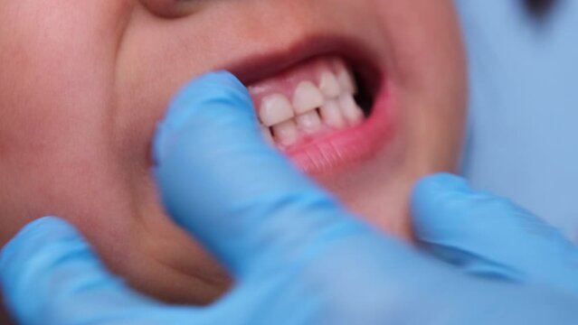 Close-up inside the oral cavity of a healthy child with beautiful rows of baby teeth. Young girl opens mouth revealing upper and lower teeth, hard palate, soft palate, dental and oral health checkup.